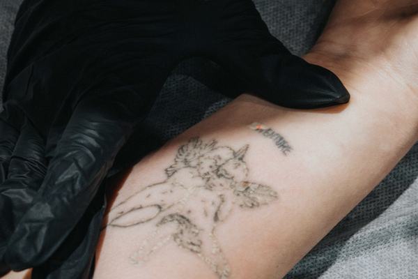 tätoveeringu laservalgendamine Tallinnas