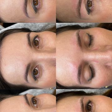 tätoveeringu heledamaks muutmine laseriga enne ja pärast protseduuri