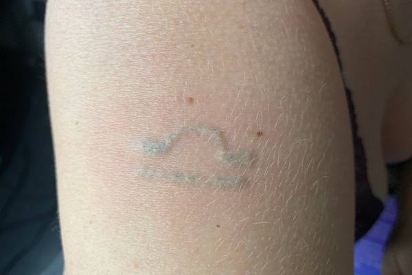 Rämoveri kasutamine tätoveeringu pigmendi eemaldamiseks